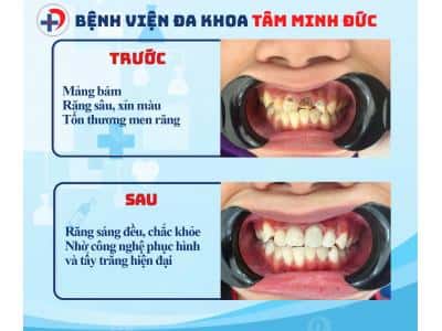 Trám răng thẩm mỹ – Không đau, tự nhiên như răng thật