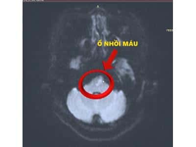 Giờ vàng cứu não – BVĐK Tâm Minh Đức