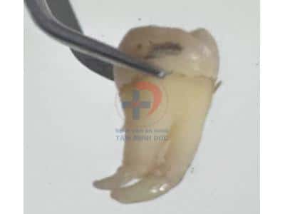 Răng khôn – tưởng dễ mà không hề dễ