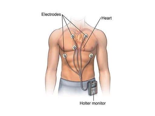 Ý NGHĨA CỦA HOLTER ĐIỆN TÂM ĐỒ TRONG CHẨN ĐOÁN RỐI LOẠN NHỊP