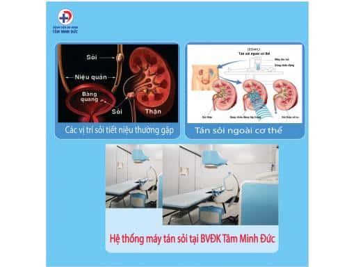 TÁN SỎI NGOÀI CƠ THỂ ĐIỀU TRỊ SỎI TIẾT NIỆU