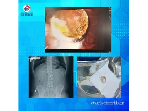HI HỮU: NAM SINH NUỐT NHẪN VÀNG CỦA CHÍNH MÌNH