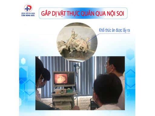 NỘI SOI GẮP DỊ VẬT THỰC QUẢN