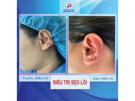 XÓA SẸO LỒI HIỆU QUẢ TẠI BVĐK TÂM MINH ĐỨC