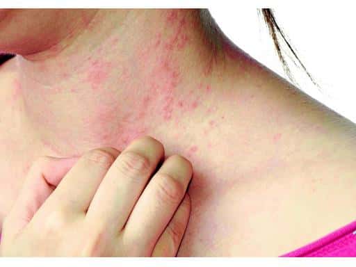 THỰC TRẠNG BỆNH NHIỄM GIUN/SÁN HIỆN NAY.